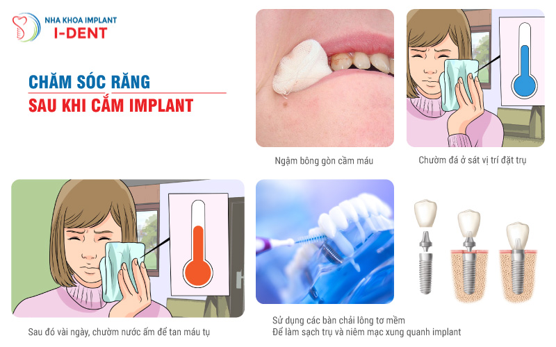 Chăm-sóc-răng-sau-khi-cắm-implant