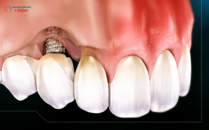 Trồng Răng Implant Có Đau Nhiều Không?