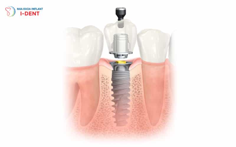 Những Điều Bạn Chưa Biết Về Phục Hình Răng Sứ Trên Implant