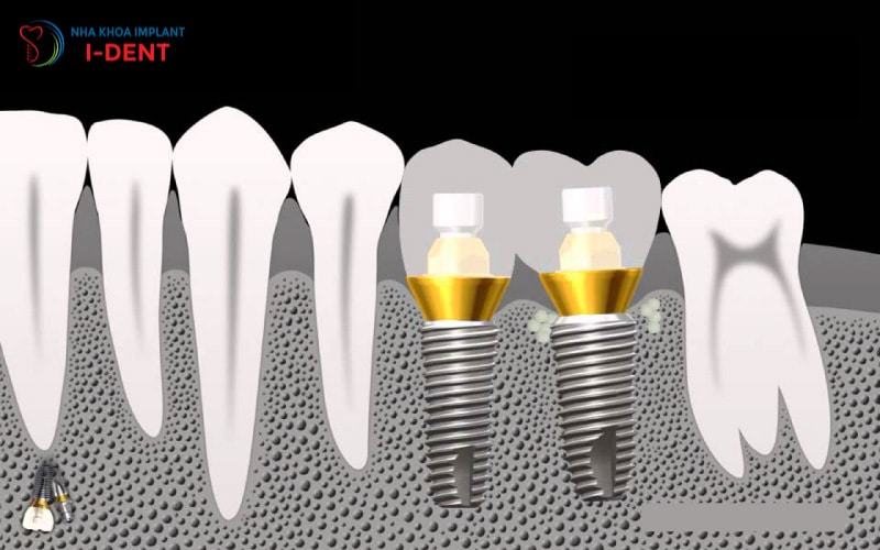 trong-implant-dentium-my-co-tot-khong