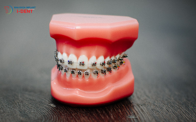 Răng Sau Khi Cấy Implant Có Niềng Được Không?