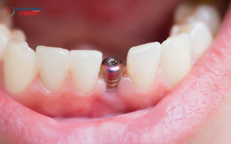 Mất Răng Cửa Có Trồng Implant Được Không?