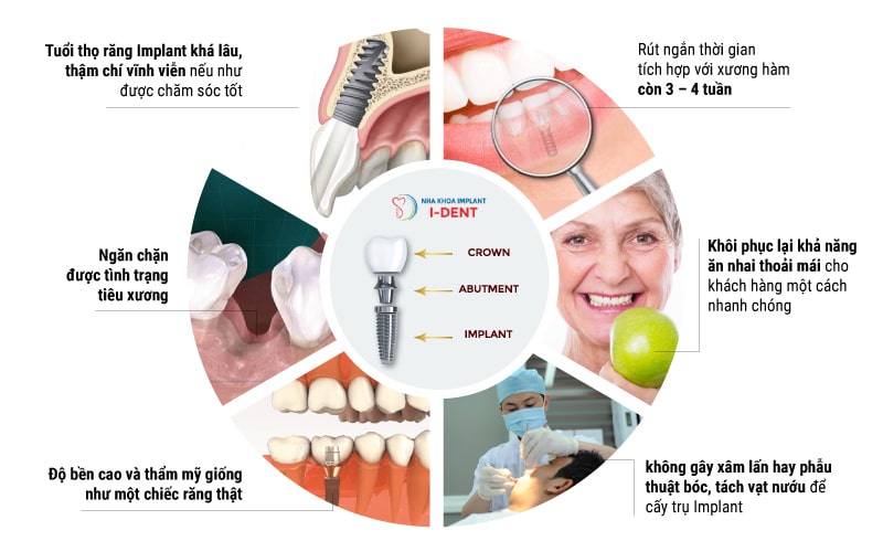 Lợi-ích-khi-trồng-răng-Implant-4S