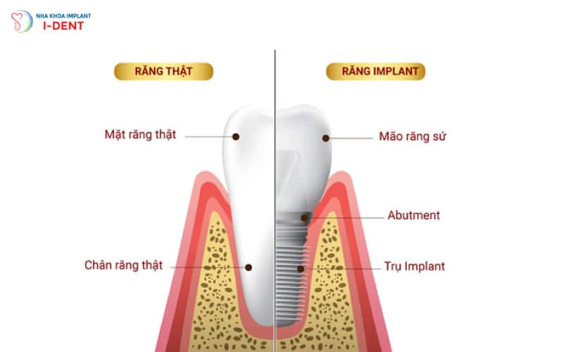 so-sánh-về-cấu-tạo-của-răng-thật-và-trụ-Implant