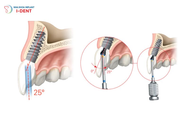 Đặc-điểm-cấu-tạo-của-Implant-Nobel-Biocare