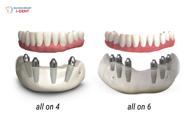 Trồng răng toàn hàm All on 4/ All on 6 có chi phí tiết kiệm hơn so với cấy trụ lẻ 
